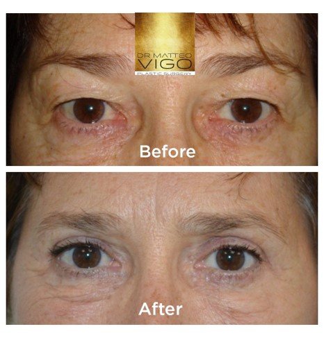 Upper blepharoplasty 6 months after