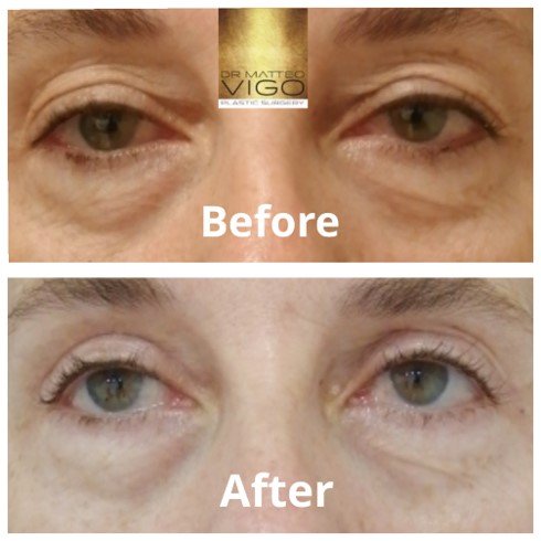 Upper blepharoplasty 6 months after