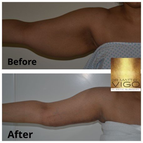 Arm lifting 6 months post op