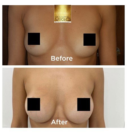 Breast augmentation with Motiva Ergonomix 335 CC