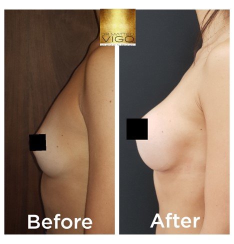 Breast augmentation with Motiva Ergonomix 335 CC