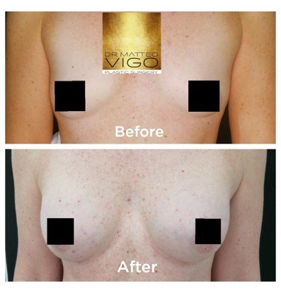 Breast augmentation with Motiva silk surface 340 CC