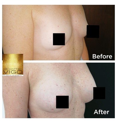 Breast augmentation with Motiva Demi Silksurface 265 CC