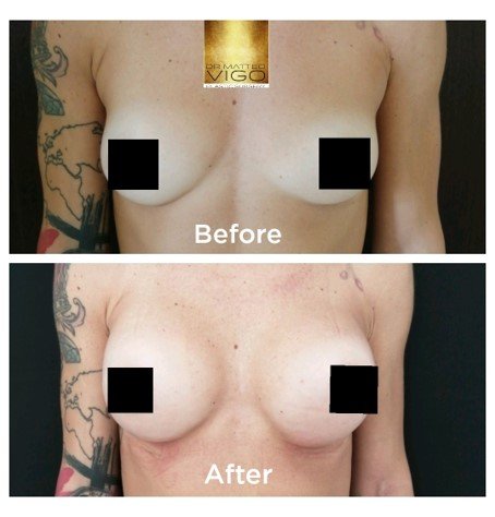 Breast augmentation with Motiva Ergonomix 275 Cc