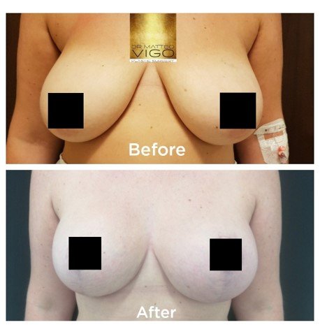 Breast Lifting with Implants MOTIVA silksurface 360 cc