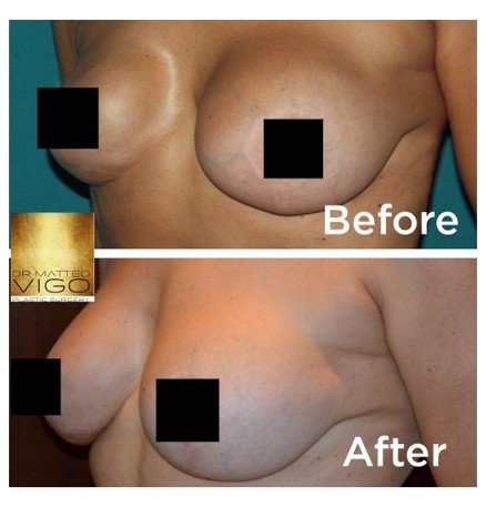 revision of previous surgery with fat grafting and lifting 
