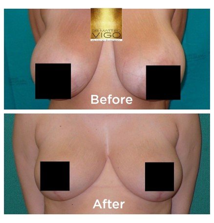 Breast Reduction