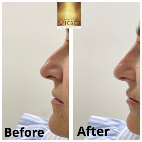 Face Fillers non surgical rhynoplasty