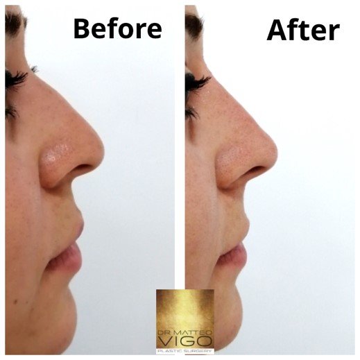Face Fillers non surgical rhinoplasty with filler