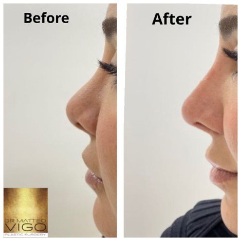 Face Fillers correction of previous rhinoplasty with filler