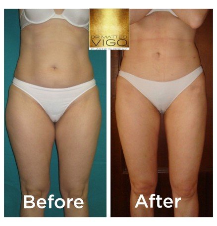 Liposuction abdomen, flanks, inner and outer thighs and knees
