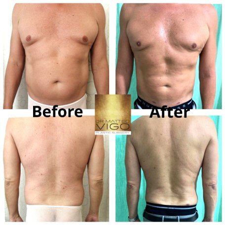 Liposuction abdomen and flanks