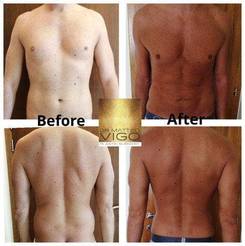 Liposuction abdomen, flanks, chest