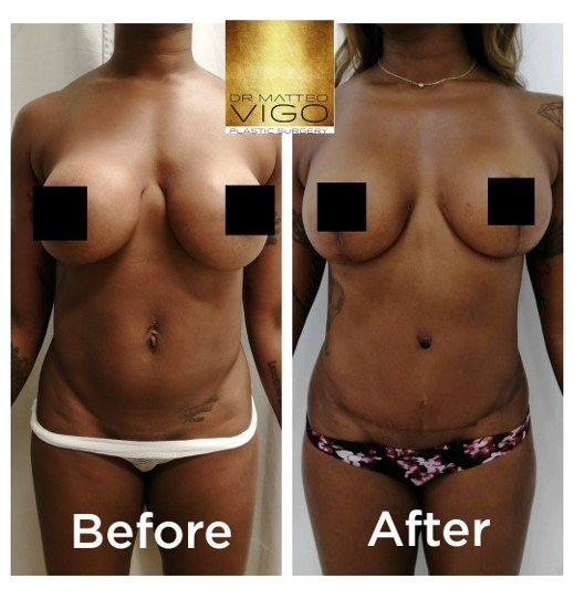 Mommy Makeover breast implant substitution with lifting and abdominoplasty