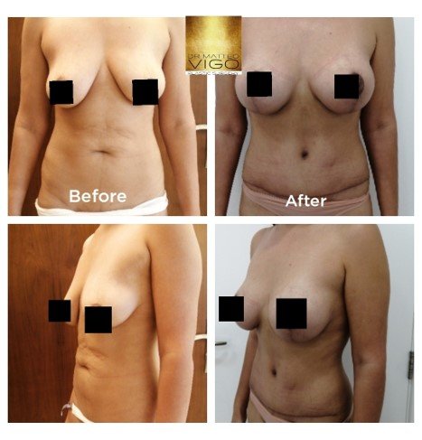 Mommy Makeover breast lifting with implants and abdominoplasty