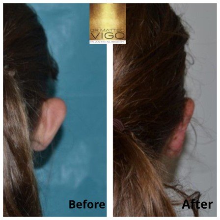 Otoplasty - Bilateral Otoplasty
