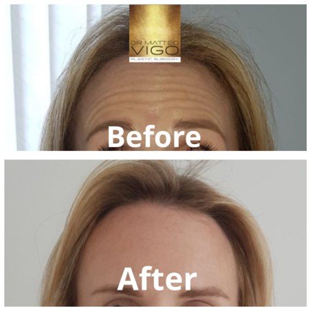 Botox forehead and glabella