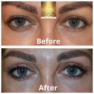 Upper blepharoplasty 6 months after