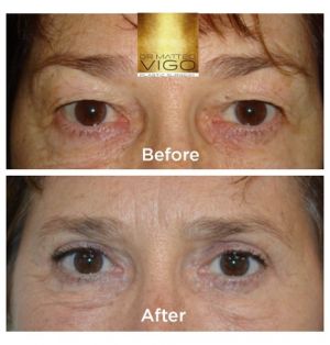 Upper blepharoplasty 6 months after