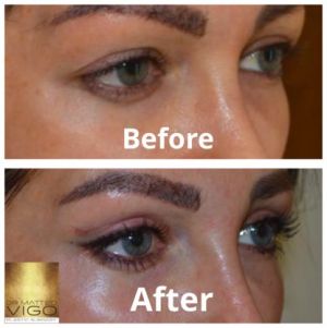 Upper blepharoplasty 6 months after