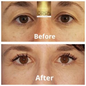 Upper blepharoplasty 6 months after