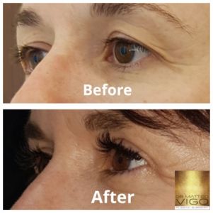 Upper blepharoplasty 6 months after