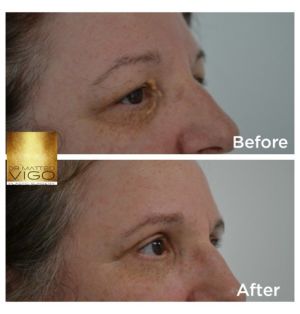 Upper blepharoplasty 6 months after