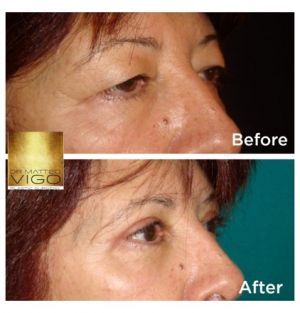 Upper blepharoplasty 6 months after