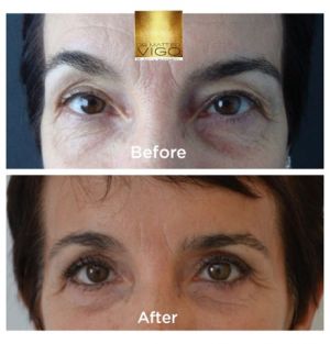 Upper blepharoplasty 6 months after