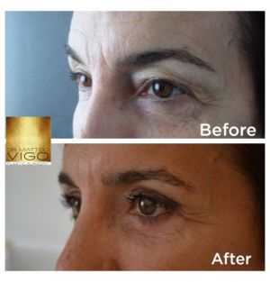 Upper blepharoplasty 6 months after