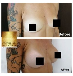 Breast augmentation with Motiva Ergonomix 275 Cc