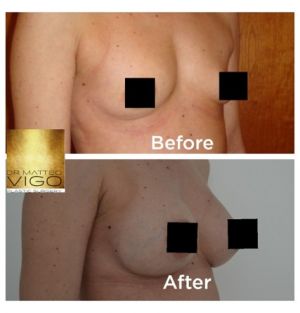 Breast augmentation with Mentor Anatomical 295 cc