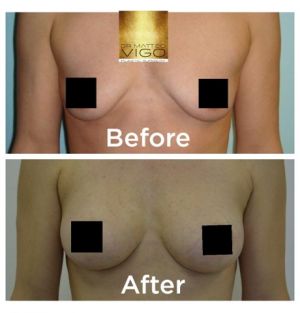 Breast augmentation with Sebbin anatomical 250cc