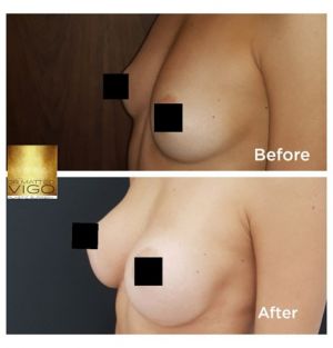 Breast augmentation with Motiva Ergonomix 335 CC