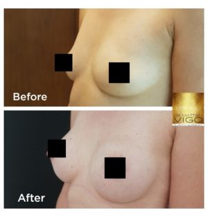 Breast augmentation with Motiva Ergonomix 275 CC
