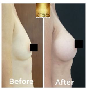 Breast augmentation with Motiva Ergonomix 275 CC