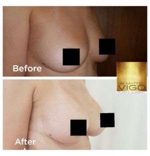 Breast augmentation with Motiva silk surface 340 CC