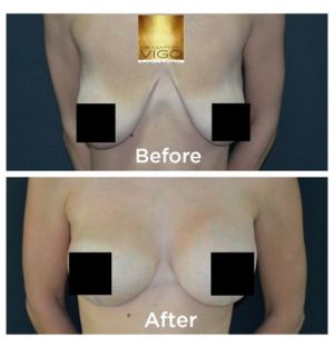 Breast Lifting with Implants Mentor Round 275 cc