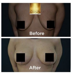 Breast Lifting with Implants Mentor round 300 cc