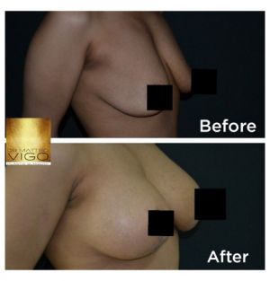 Breast Lifting with Implants Mentor round 300 cc