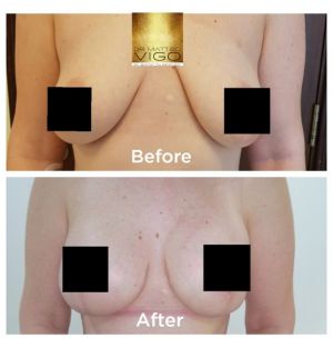 Breast Lifting with Implants MOTIVA silksurface 320 cc