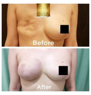 Right Breast Reconstruction after mastectomy with anatomical implant 475 cc
