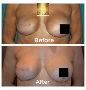 revision of previous surgery with fat grafting and lifting 