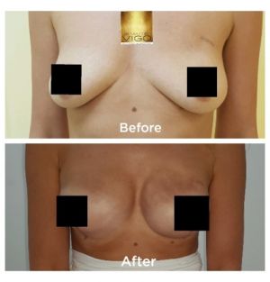 Breast Reconstruction after bilateral mastectomy with Sebbin anatomical implants 470 cc 