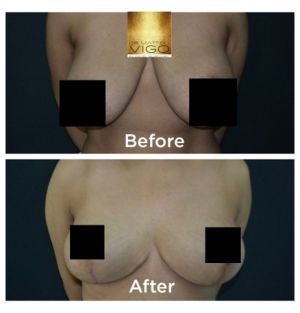 Breast Reduction