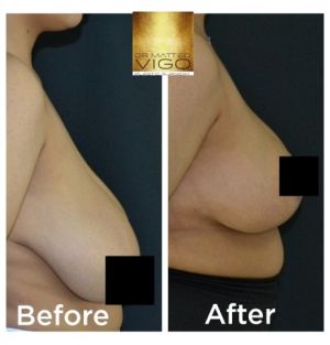 Breast Reduction