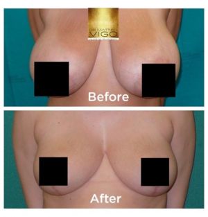 Breast Reduction