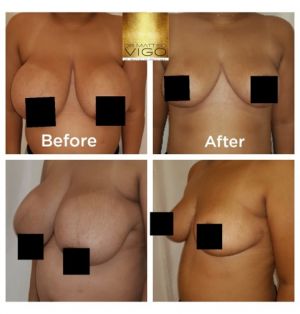 Breast Reduction