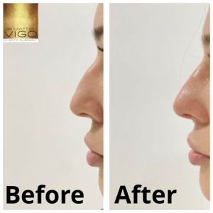 Face Fillers non surgical rhynoplasty