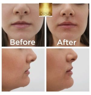 Face Fillers Lip filler